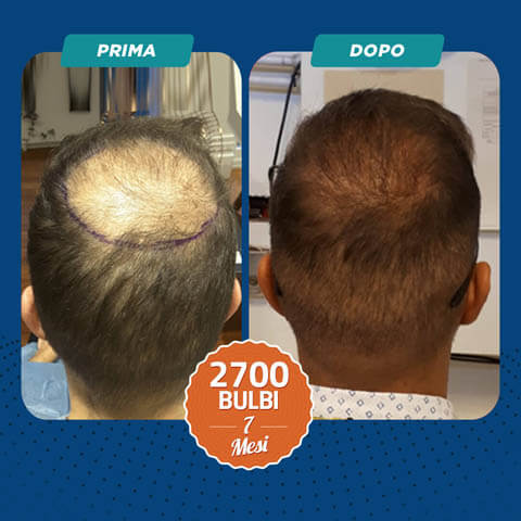Trapianto di capelli DHI Prima e dopo 2700 Bulbi