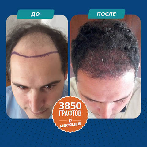 Пересадка волос FUE до и после 3850 графты
