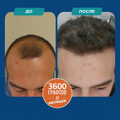 Пересадка волос FUE до и после 3600 графты