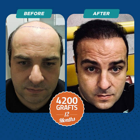 Sapphire FUE Hair Transplant Before and After 4200 Grafts
