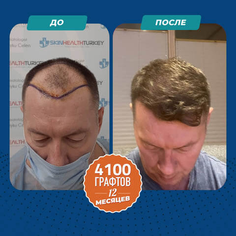 Сапфировая пересадка волос FUE до и после 4100 графты
