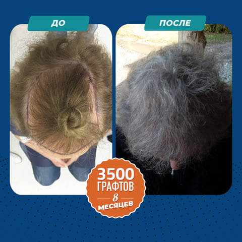 Пересадка небритых волос до и после 3500 графты